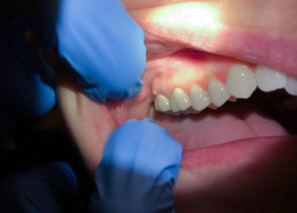 Best Emergency Tooth Extraction in Farr West, UT